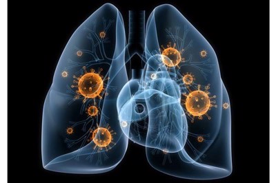 Nguyên nhân gây viêm phổi là gì? Làm sao để phòng tránh? PGS. TS Nguyễn Thị Ngọc Dinh giải đáp
